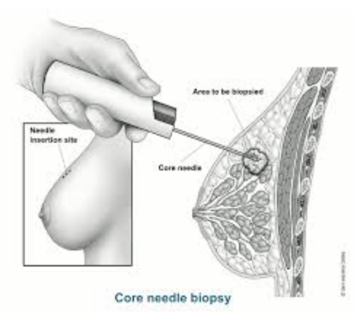 بیوپسی سوزنی از توده ی پستان